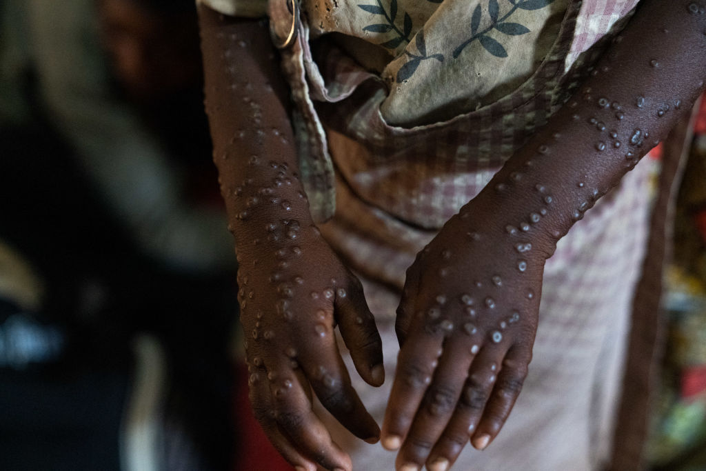 L'évolution du Monkeypox atteint une souche mortelle, désormais détectée aux États-Unis
